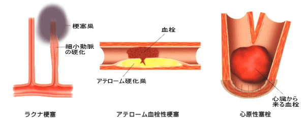 脳梗塞の原因